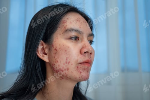 Preview: Acne on face because the disorders of sebaceous glands productions. Acne or a Cosmetic