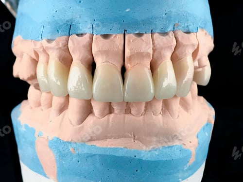 Preview: Dental porcelain prosthesis implant tooth in dental laboratory. Front view. Selective focus.