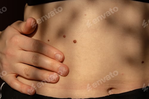 Preview: Birthmarks on skin Close up detail of the bare skin Sun Exposure effect on skin, Health Effects of U