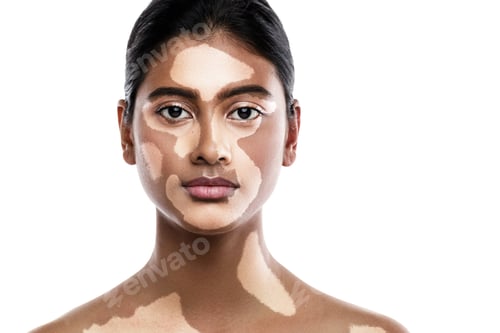 Preview: Beautiful South Asian woman with vitiligo skin disorder against white background