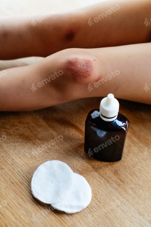 Preview: Deep scratches on the skin on the kids knee
