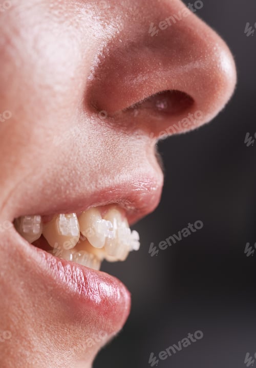 Preview: Young woman with braces on teeth.
