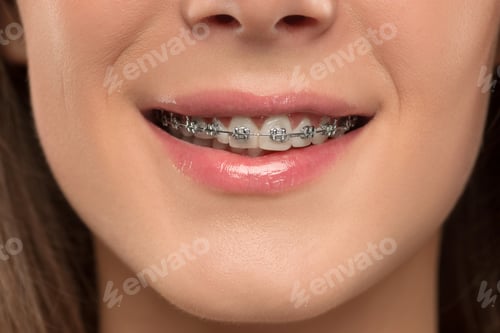 Preview: Beautiful young woman with teeth braces