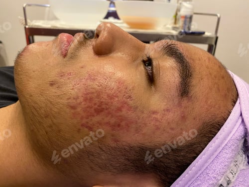 Preview: Acne problems and deep scarring on a teenage boy face