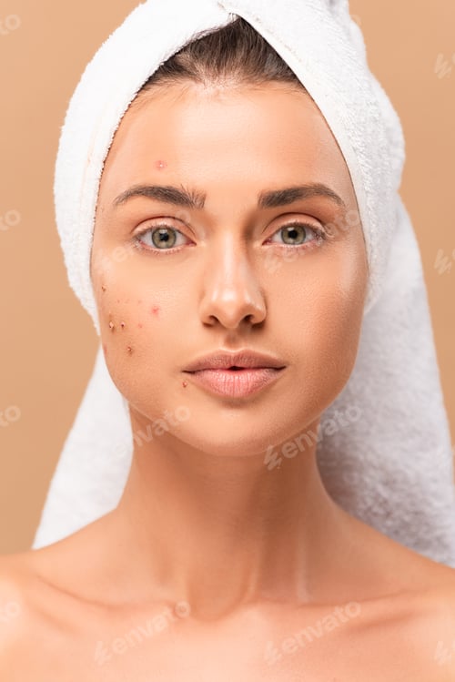 Preview: nude girl in towel with acne on face looking at camera isolated on beige