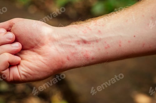 Preview: Woman with itching from biting insect in body in tropical jungle forest