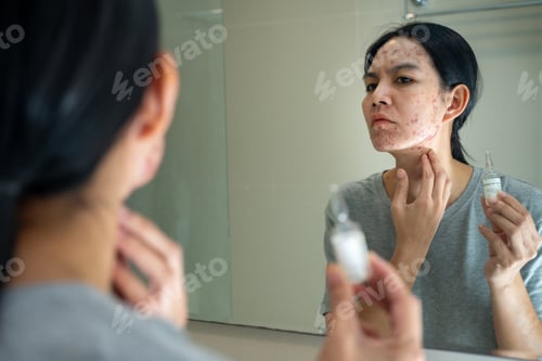 Preview: Acne on face because the disorders of sebaceous glands productions. Acne or a Cosmetic Allergy.