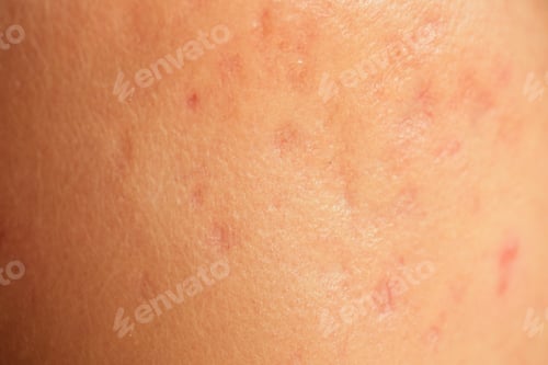 Preview: post-acne, scars and red festering pimples on the skin of the face.