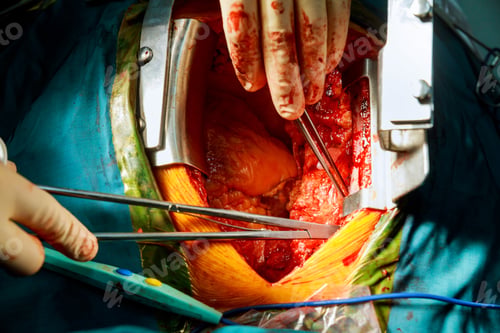 Preview: Surgeon hands are tying a knot during the open heart procedure chest during heart surgery