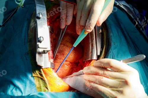 Preview: Disposable electrosurgical pencil. Incision on the chest. Cutting the chest during an operation on