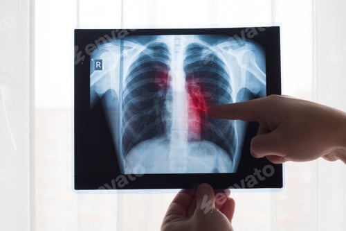 Preview: Lung radiography concept. Radiology doctor examining at chest x ray film of patient Lung Cancer or
