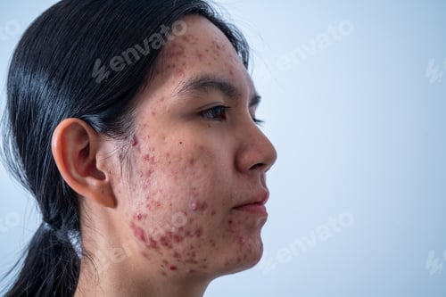 Preview: Acne on face because the disorders of sebaceous glands productions. Acne or a Cosmetic Allergy.