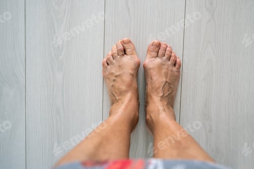 Preview: Senior woman varicose bare feet with valgus deformity. Activity pain, orthopaedics need, bunion