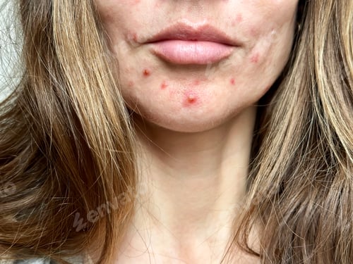 Preview: Close Up Of Chin On Female Face With Acne