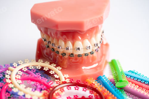 Preview: Orthodontic ligatures rings and ties, elastic rubber bands on orthodontic braces.