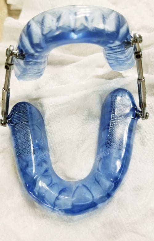 Preview: Obstructive Sleep Apnea! Mandibular Oral Device!