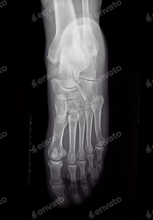 Preview: an x-ray of the sole of the human foot