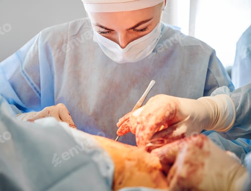 Preview: Female doctor doing abdominoplasty surgery in operating room.