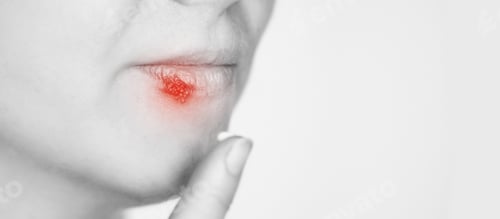 Preview: Girl with herpes. Sick mouth symptom. Lips cold