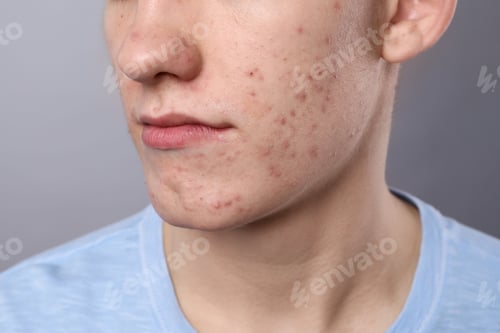 Preview: Young man with acne problem on grey background, closeup