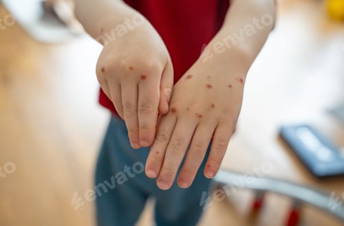 Preview: Pimples on a child's hands from the Coxsackie virus. Coxsackievirus. A common viral infection