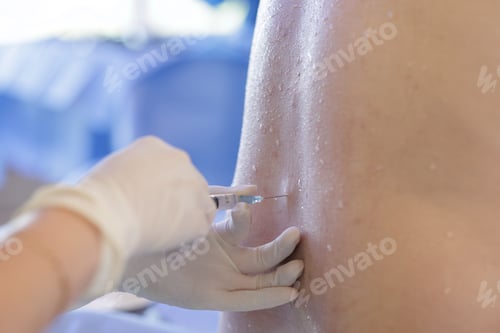 Preview: Spinal or epidural anesthesia injection in lumbar back during sterile preparation