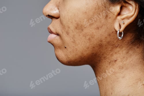 Preview: Woman with acne scars on face