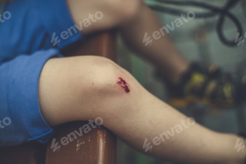 Preview: Selective closeup shot of a child's knee with a wound on a blurry background