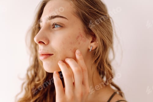 Preview: Portrait of a beautiful woman with inflammations on the skin of her face. Medicine and cosmetology.