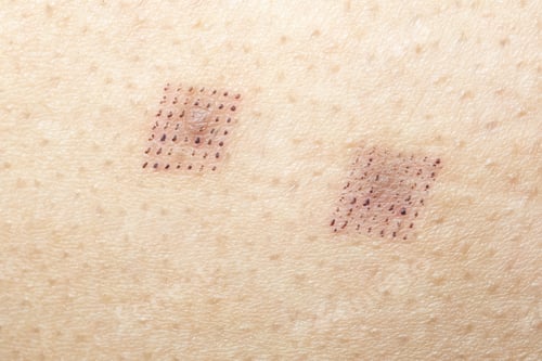Preview: Marks after laser hair or scar removal from the skin. CO2 technique.