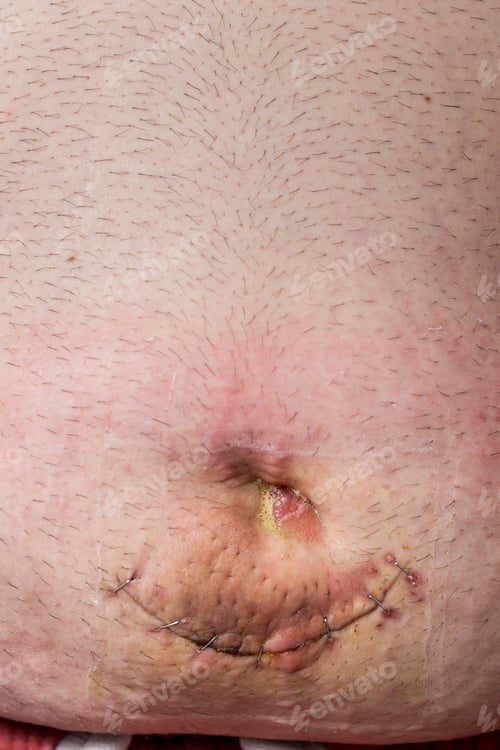 Preview: Umbilical hernia wound