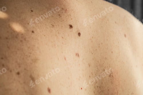 Preview: Skin on a man back with scattered moles