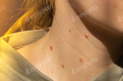 Preview: Birthmarks on skin Close up detail of the bare skin Sun Exposure effect on skin, Health Effects of U