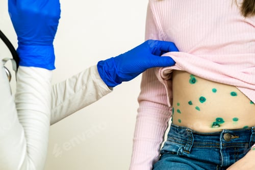 Preview: Doctor examining a child covered with green rashes on stomach ill with chickenpox