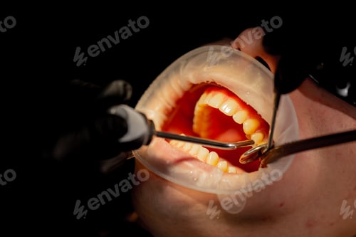 Preview: close up dental office girl dentist doing cleaning to young guy before the whitening procedure
