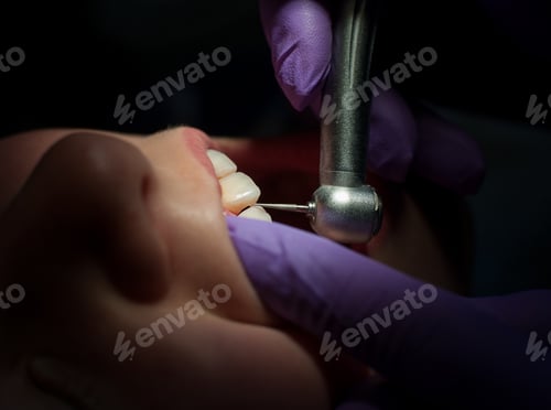 Preview: Dental drilling procedure on beautiful teeth and open mouth