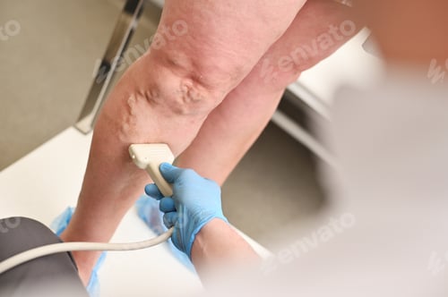 Preview: a phlebologist does an ultrasound of the veins of a patient with varicose veins.