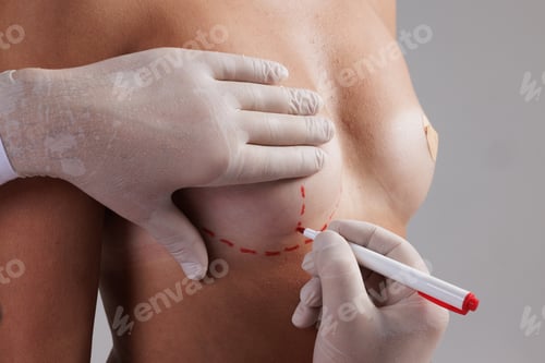 Preview: Doctor Marks Area for Surgery with Marker