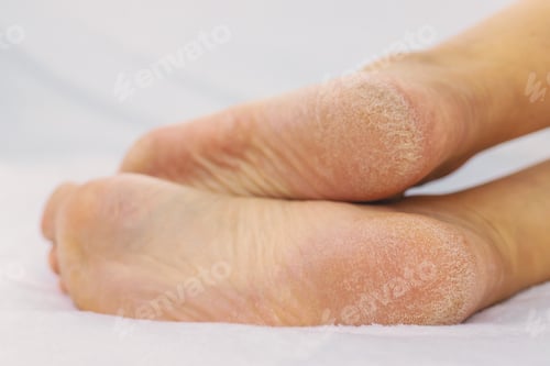 Preview: Female feet dry skin on the heels. Selective focus.