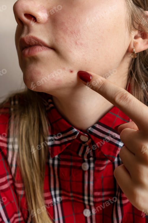 Preview: Woman shows a pimple with her finger.