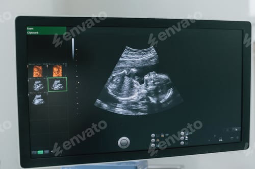 Preview: Pregnant baby infant ultrasound display. Conception of health care