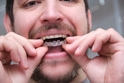 Preview: Close up of young latin man wearing orthodontic silicone trainer or invisible braces aligner