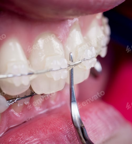 Preview: Dentist checking up teeth with ceramic brackets using probe at the dental office.