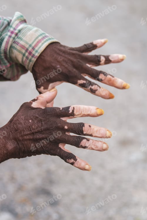 Preview: Vertical of the hands of an old black man with the vitiligo skin disease on the blurred background