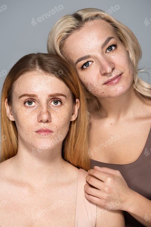 Preview: Women with acne and freckled skin posing together isolated on grey