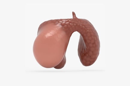 Preview: Adenocarcinoma Thyroid: Solid Variant with Papillary Features