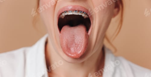 Preview: Close-up of a woman showing her tongue and braces on her teeth