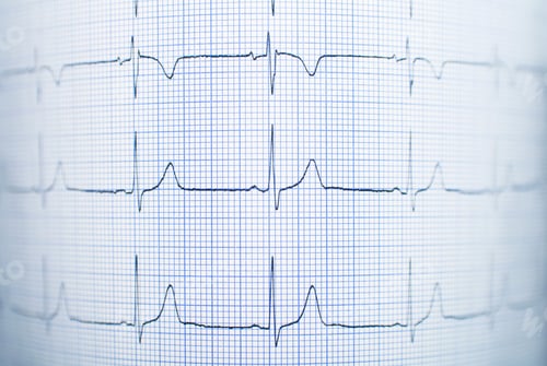 Preview: Healthy electrocardiogram