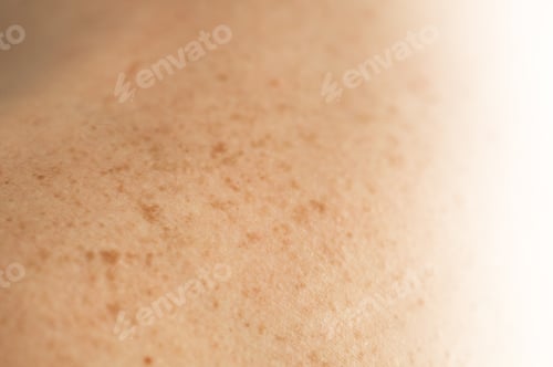 Preview: Skin on a man back with scattered moles