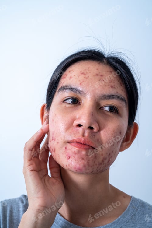 Preview: Acne on face because the disorders of sebaceous glands productions. Acne or a Cosmetic Allergy.